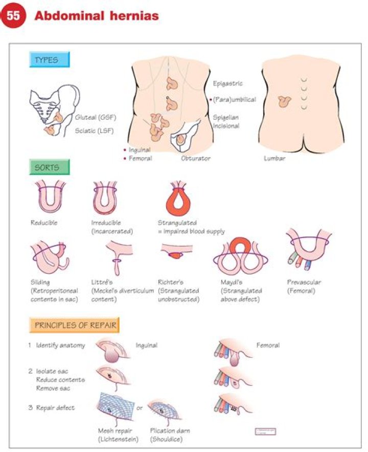 Are abdominal hernias common?