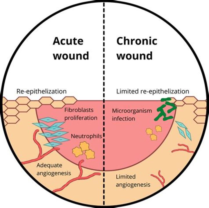 Are wound infections common?