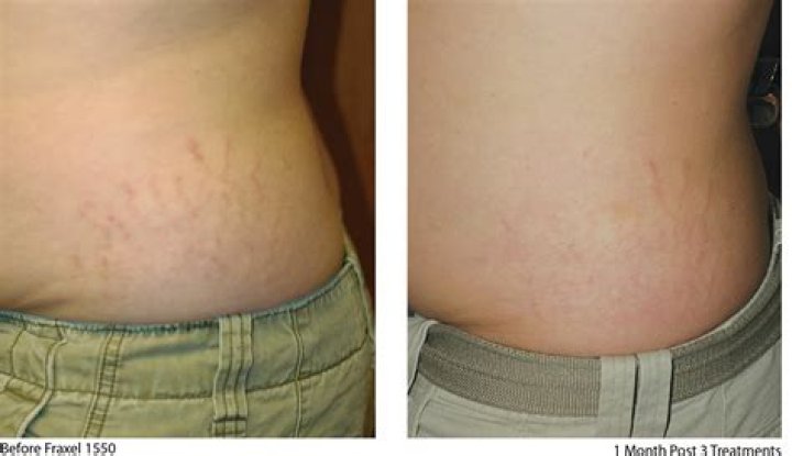 Can a stretch mark burst?