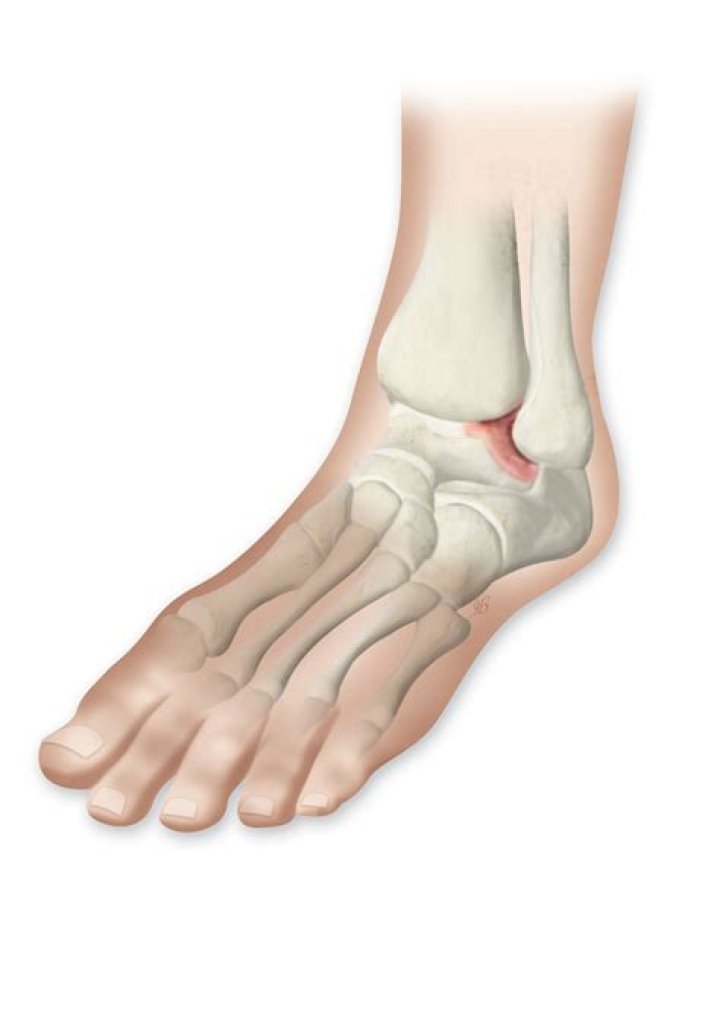 Can ankle arthritis be cured?