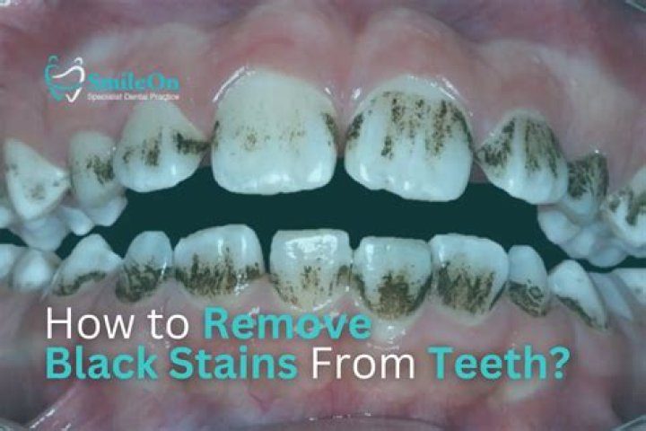 Can black stains on teeth be removed?