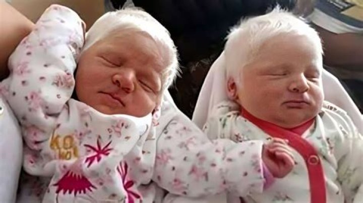 Can you be born with white hair and not be albino?