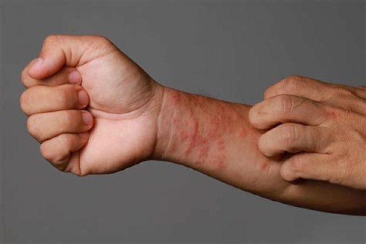 Does eczema turn red healing?