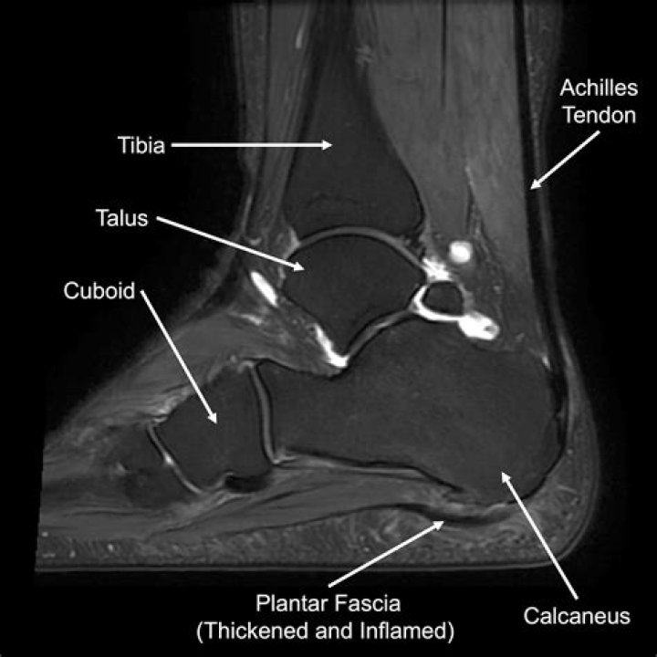 Does plantar fasciitis show on MRI?