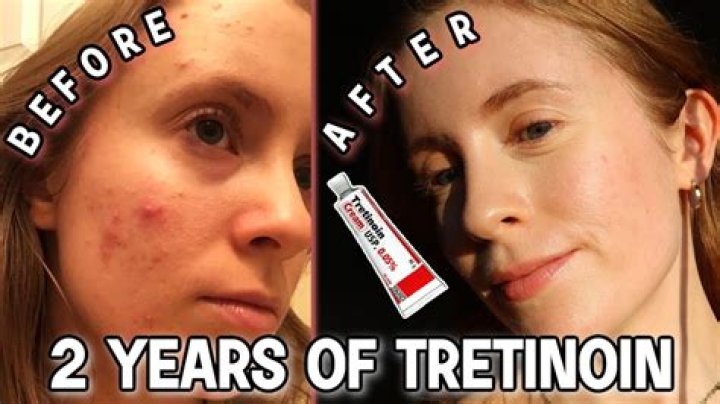 Does tretinoin help pitted scars?