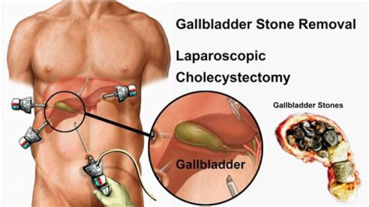 Is gallbladder surgery a major surgery?
