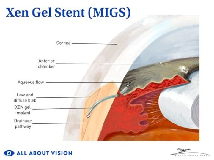 What is Xen gel stent?
